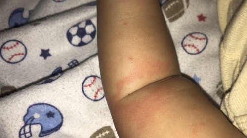 Muncul bintik merah pada bayi, sempet demam cuma sudah turun skrg tapi ruamnya tidak hilang, mohon bantu dijawab bun🙏🏻