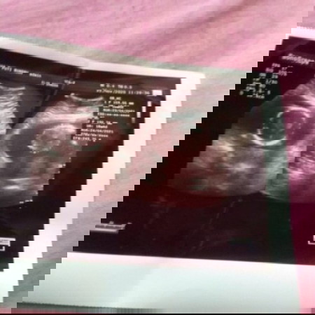 Bun mau tny in kan usia 5 bln apakah akurat jenis kelamin ny, dokter blng in cwe, apkh bs berubah