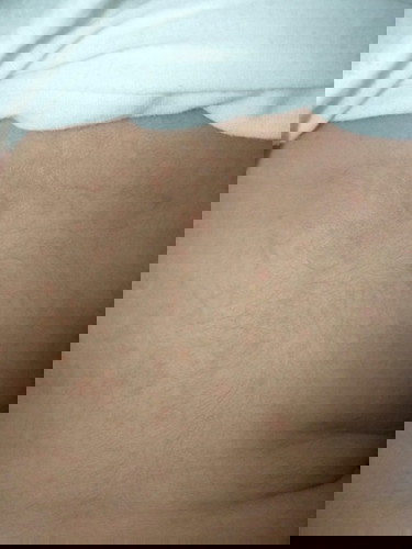 Rashes sa likod?