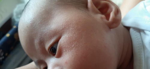 Flakes on face