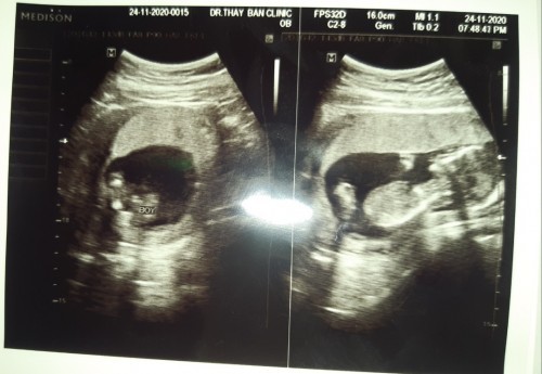 16W กำหนดคลอด 15 พ.ค.64 ค๊าบ เพศชาย❤👶