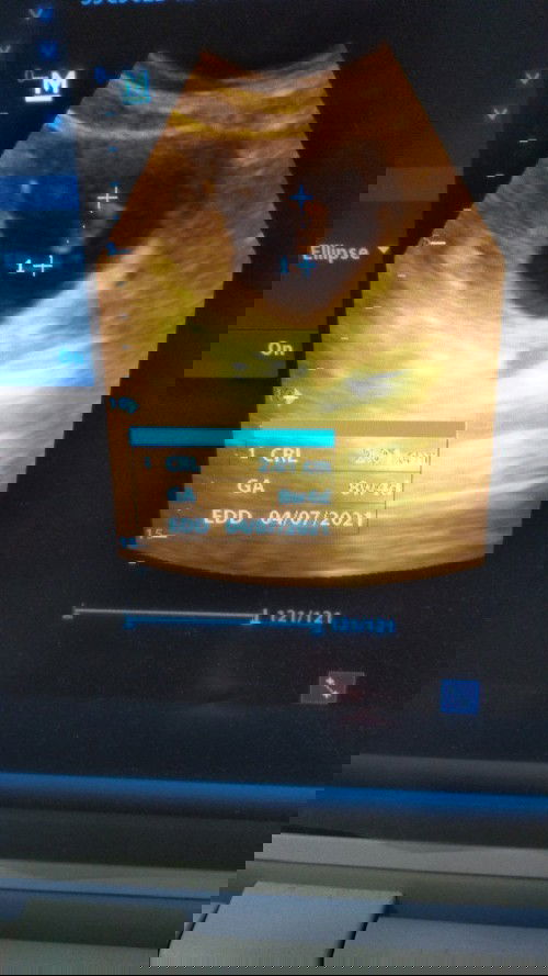 Usia kehamilan dan janin berbeda jauh