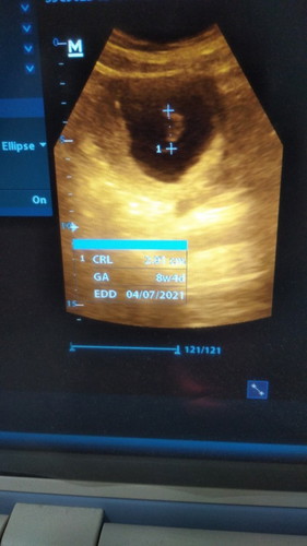 Usia kehamilan dan janin berbeda jauh