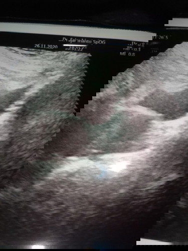 Bund sya kmrn kedokter katany masih penebalan dinding rahmi blm terlihat janin nya,shere dong bund