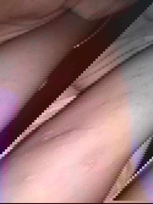 Cacar air usia 13bulan