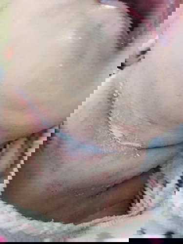 ซอกคอแดงเเละมีผื่นเต็มไปหมด