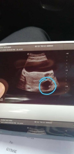 Sy cek upt naik double line semalam sy pergi check up doc kata sy ada simple cyst dibhagian kiri 4cm