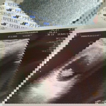 Janin tidak berdetak