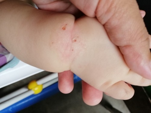 Skin rashes or skin asthma