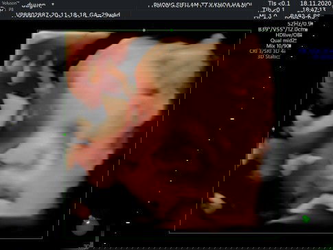 29 tuần 4 ngày bé nhà e đc 1711g chiều dài lưỡng đỉnh là 80mm và xương đùi là 58mm vậy là đc chưa ạ.