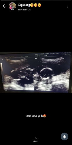 Bun mau tanya doang usia kandungan 17 week,trus pas usg udah ketauan jk nya,itu masih rubah ga ya?