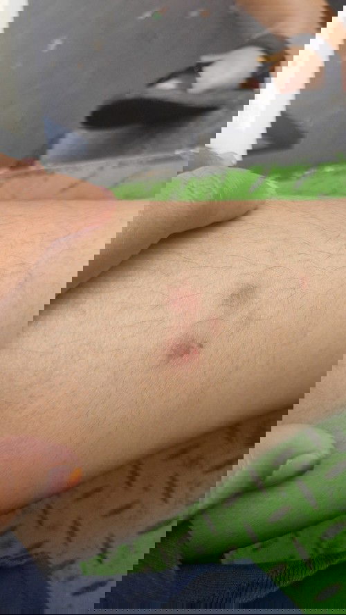 Bun,ada yg pernah ngalamin gatal" selama hamil ? Kata orang tua bawaan bayi ,tapi ganggu banget