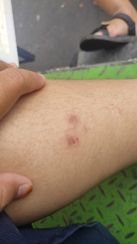 Bun,ada yg pernah ngalamin gatal" selama hamil ? Kata orang tua bawaan bayi ,tapi ganggu banget