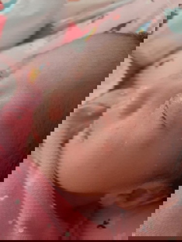 RASHES