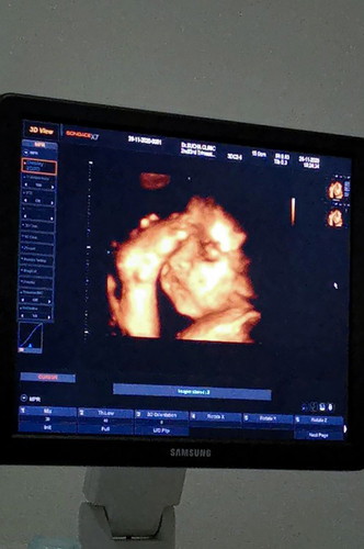 ซาว4D 31W ลุ้นๆว่าจะต้องผ่าหรือป่าวครับ