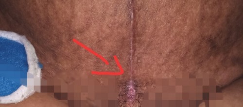 CS wound ...