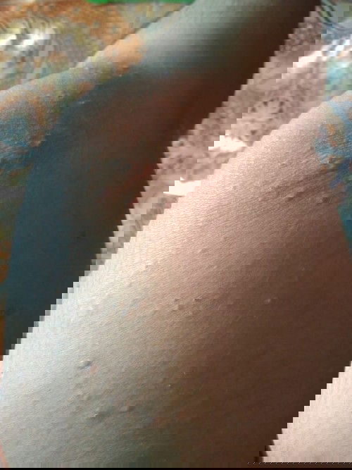 ผื่นคันหลังคลอด