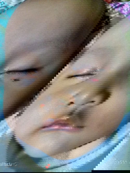 ruam merah di bawah mata