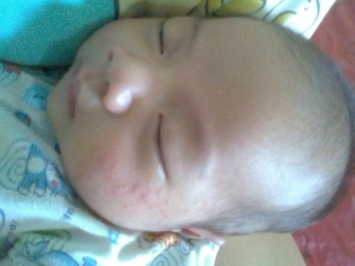 หนูอายุหนึ่งเดือนเป็นผืนแดงที่เเก้มไม่รุ้สาเหตุอยากรุ้วิธีแก้ใครพอรุ้แนะนำวิธีแก้หน่อยจ้า