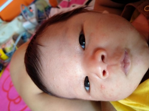 ผดบนใบหน้า