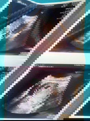 ตั้งครรภ์ได้4สัปดาห์ตรวจเจอถุงน้ำที่รังไข่ด้านซ้ายโต5เซน 😓