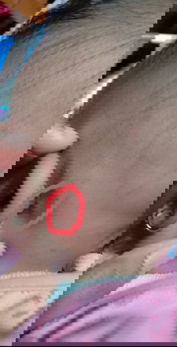 Benjolan belakang telinga