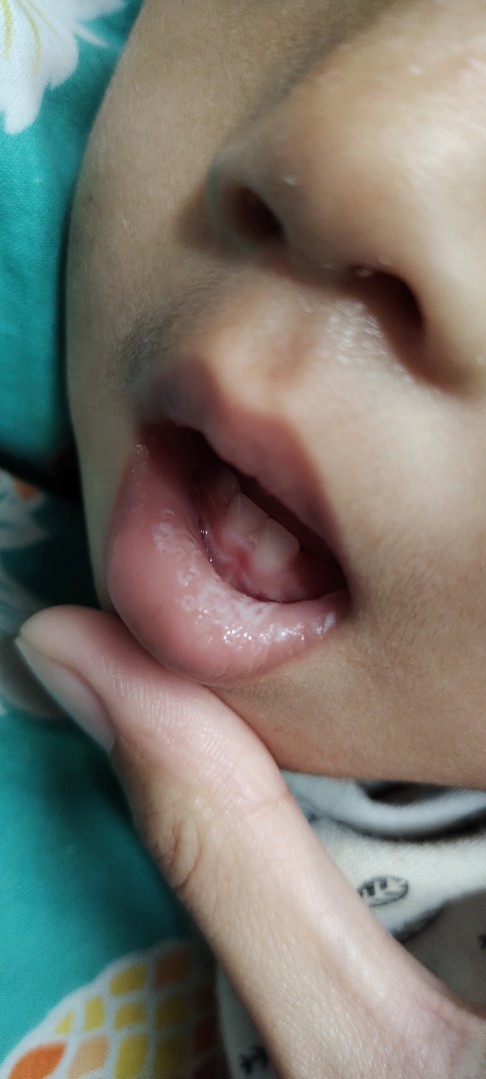 Sariawan / jamur baby