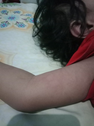 Gatal gatal di badan