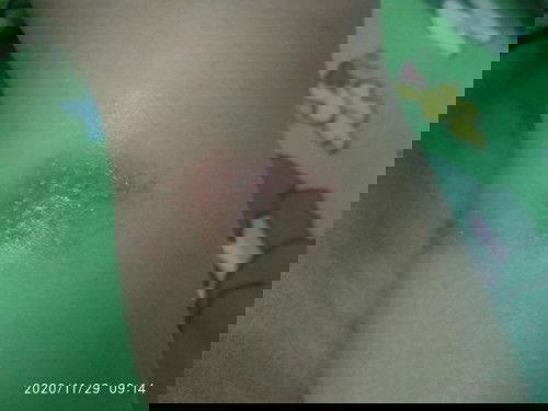 pernah kah anak bunda alami seperti ini