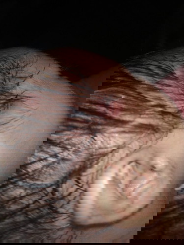 Just wanna ask po bakit po pa balik balik ang boils or yung hubag sa ulo ni baby?