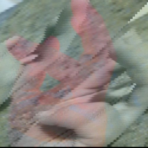 Ngứa hai tay và nổi mụn