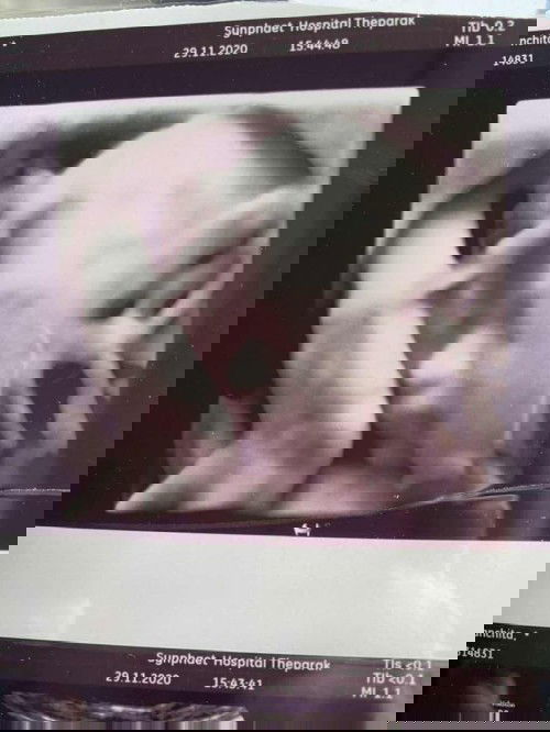 จากความดันต่ำต้องมาเจอความดันสูง