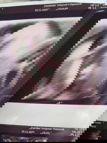 จากความดันต่ำต้องมาเจอความดันสูง