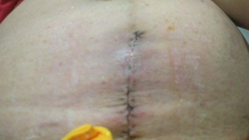 Cs wound infected or not