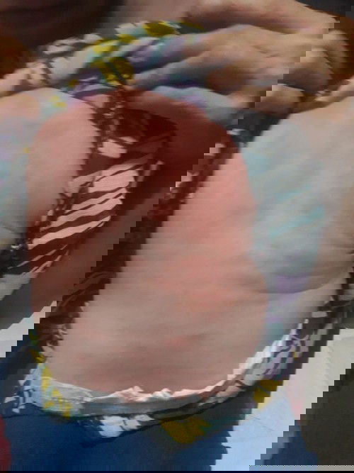 Cho em hỏi bé bị như vậy là bị sao v ạ?