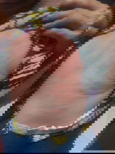 Cho em hỏi bé bị như vậy là bị sao v ạ?