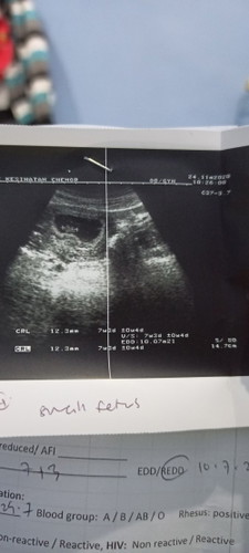 Salam.. normal ke kalau dh 9minggu..jantung dh ad. Cume Dr ckp fetus kecil. Risau pulak.. 😔