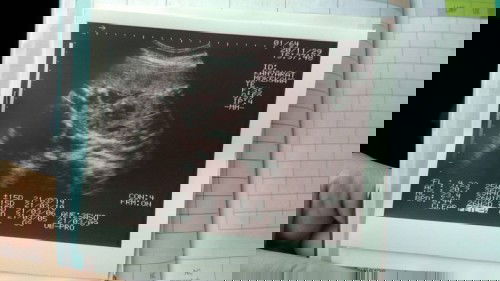 สอบถามคะหมอบอกว่า น้องนอนหนีบขา แต่ระหว่างขาไม่มีอะไรโผล่ออกมา  เป็นเด็ดหญิง75%  แบบนี้ชัวร์ไหมคะ