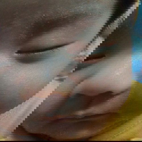 pahelp po milk allergy rashes