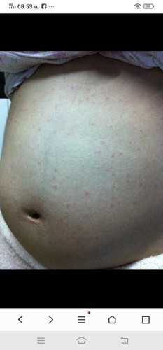 แม่ๆบ้านไหน มีผื่นขึ้นแบบนี้บ้างคะ