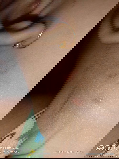 Bun mau nanya nih ,itu anak saya kena herpes apa gigitan serangga iya???