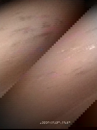 stretch mark