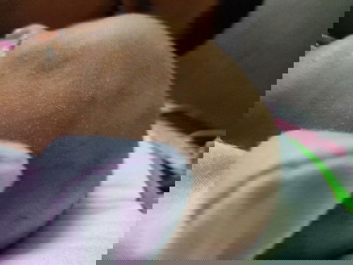 Ruam ke? Ruam ni hilang sendiri atau kena letak ubat?