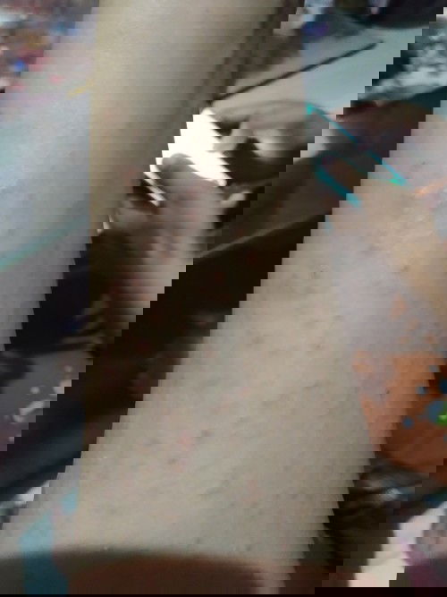 Gatal-gatal g kunjung sembuh