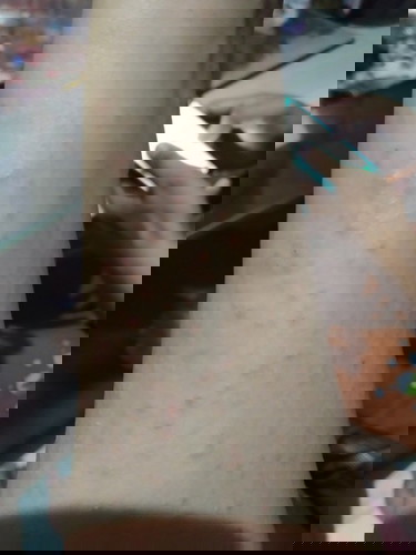 Gatal-gatal g kunjung sembuh