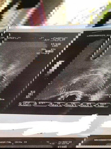 ท้องแรก อายุ19ปี