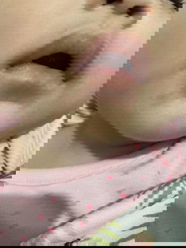 Rash on baby’s mouth