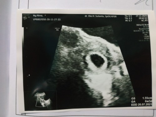 Hasil cek ke bidan dan Usg berbeda