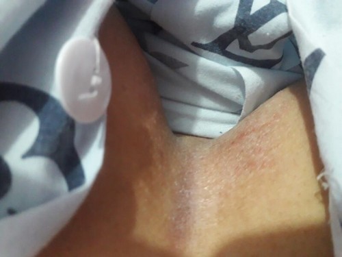 เราคันร่องนมมากค่ะ