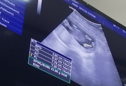 พอจะบอกเพศได้ไหมคะ14W2Dคุณหมอไม่ได้บอกไว้ หรือยังไม่เห็นคุณแม่แอปตื่นเต้นใครดูเป็นช่วยไบ้ๆให้หน่อย